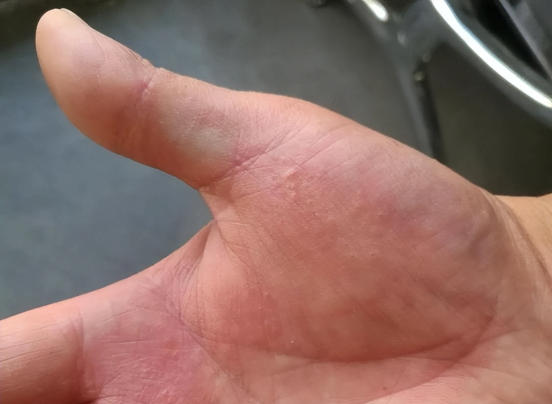 手上起小水泡圖片，原因、治療與預防，手上起小水泡，圖片詳解、成因、治療與預防方法