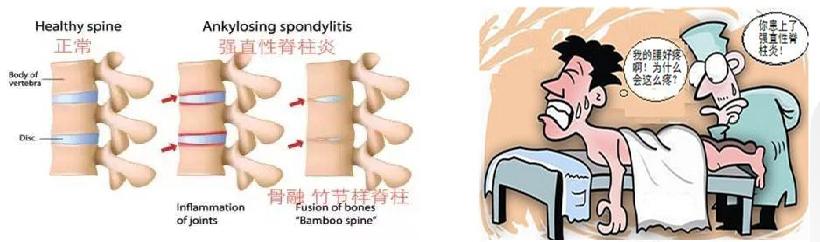 強直性脊柱炎的早期癥狀是什么？深入了解與應對，強直性脊柱炎早期癥狀解析，深入了解與應對策略