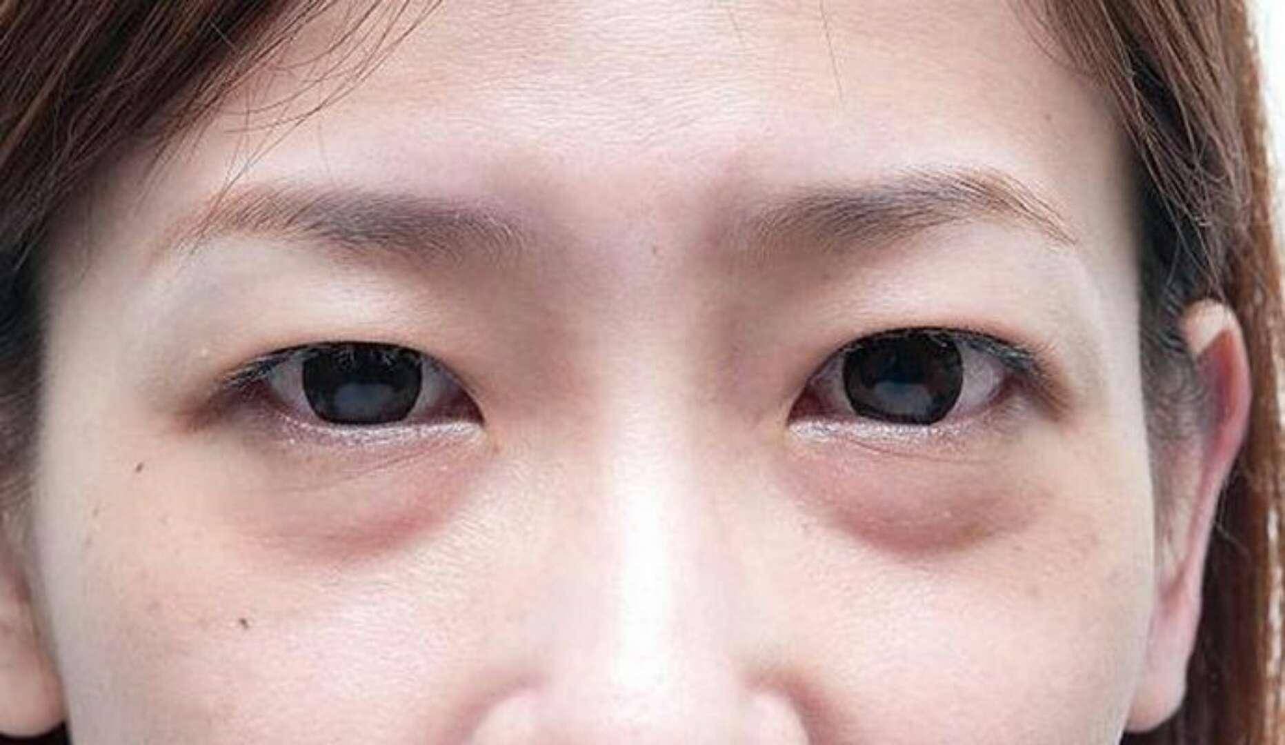 割眼袋，了解、準(zhǔn)備與恢復(fù)的全流程指南，割眼袋全程指南，從了解、準(zhǔn)備到恢復(fù)全攻略